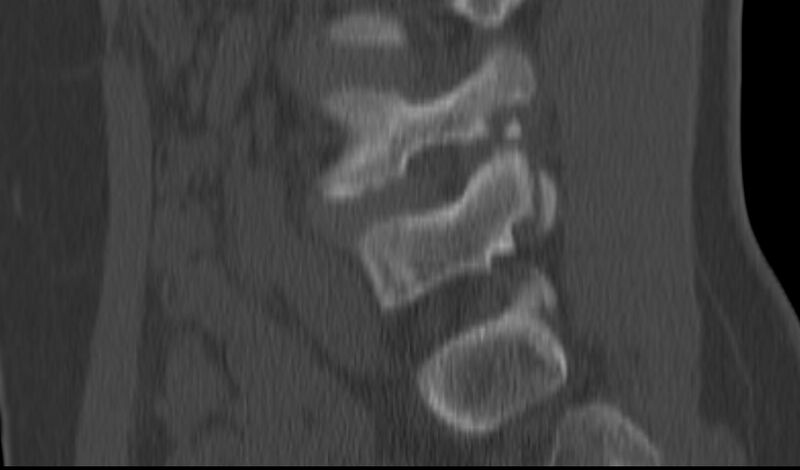 File:Bilateral pars defect (Radiopaedia 26691-26846 Sagittal bone window 42).jpg