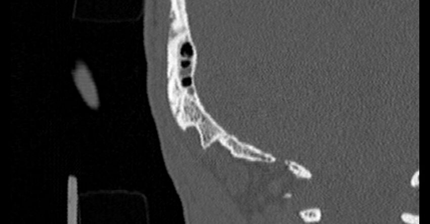 Bilateral temporal bone fractures (Radiopaedia 29482-29970 Coronal non-contrast 191).jpg