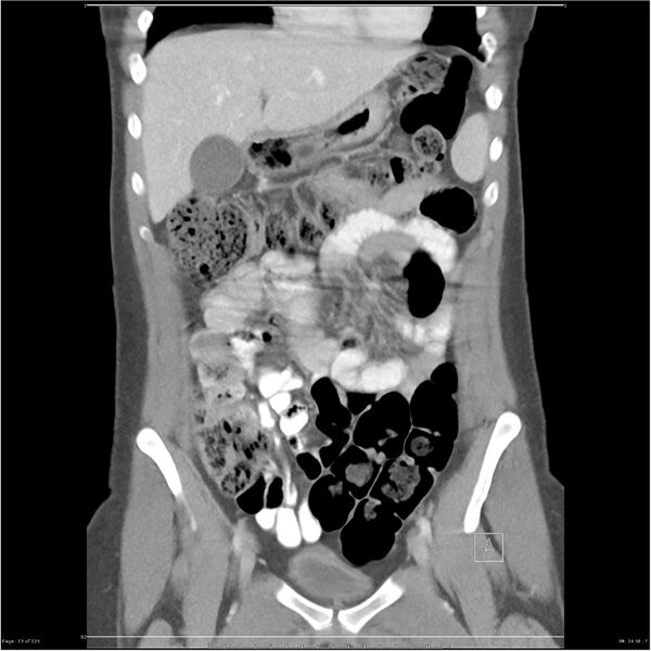 File:Bilateral ureteritis and cystitis (Radiopaedia 25340-25594 B 13).jpg