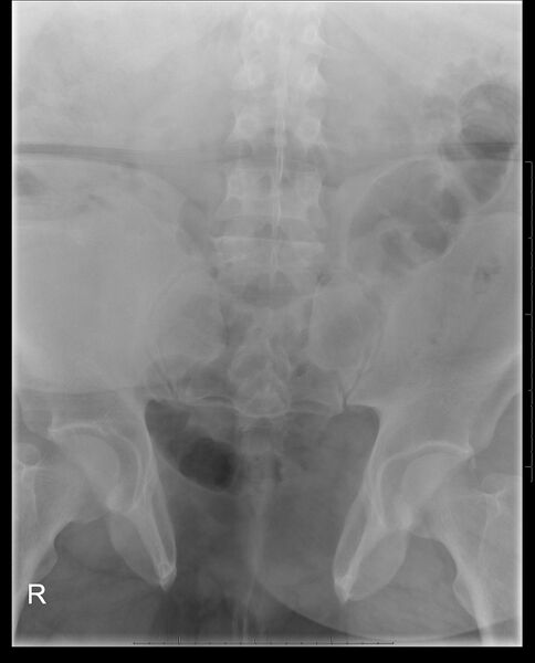 File:Bladder exstrophy - post surgery (Radiopaedia 35763-37313 Frontal 1).jpg