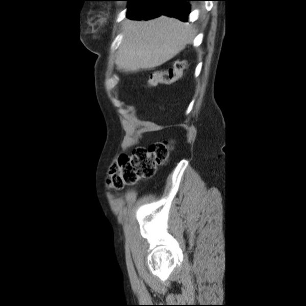 File:Bladder tumor detected on trauma CT (Radiopaedia 51809-57609 E 63).jpg