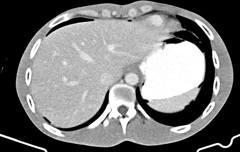 File:Blunt injury to the small bowel (Radiopaedia 74953-85987 A 8).jpg