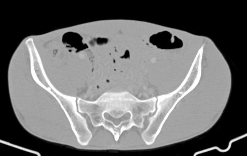 File:Blunt injury to the small bowel (Radiopaedia 74953-85987 Axial Wide 75).jpg