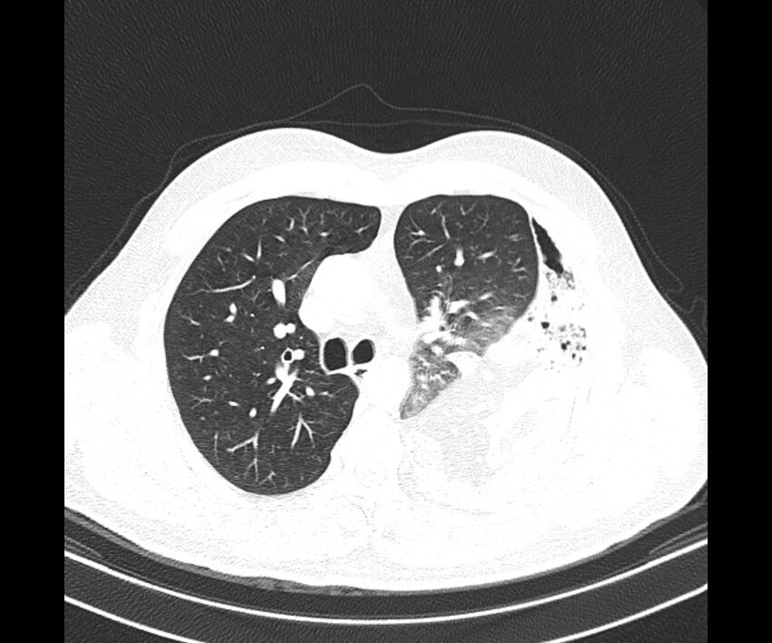 Bochdalek hernia - adult presentation (Radiopaedia 74897-85925 Axial lung window 16).jpg