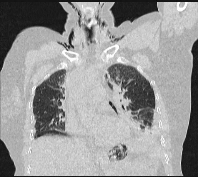 File:Boerhaave syndrome (Radiopaedia 45644-49799 Coronal lung window 28).jpg
