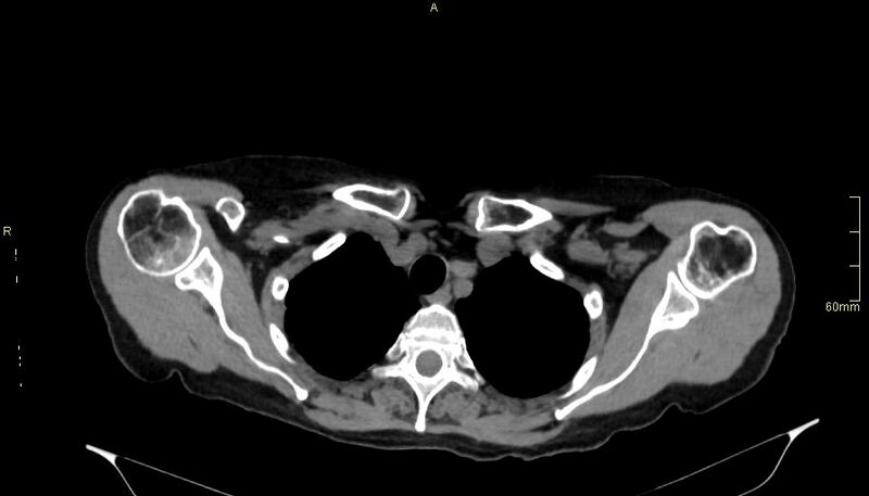File:Brachial artery foreign body (Radiopaedia 54583-60820 Axial non-contrast 16).jpg