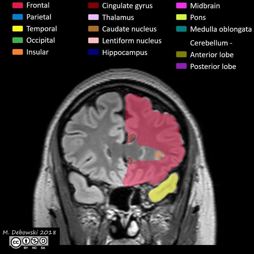 Brain lobes - annotated MRI (Radiopaedia 61691-69700 Coronal 19).JPG