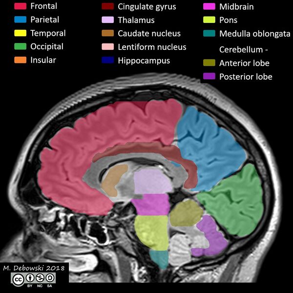 File:Brain lobes - annotated MRI (Radiopaedia 61691-69700 Sagittal 44).JPG