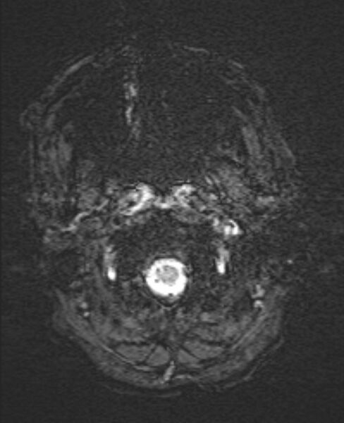 File:Brain metastases - lung cancer primary (Radiopaedia 75060-86115 Axial SWI 3).jpg
