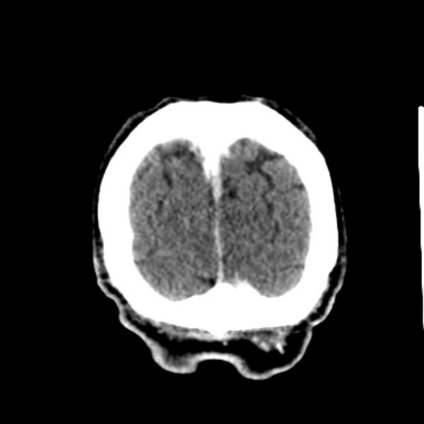 File:Brain metastases from lung cancer (Radiopaedia 27849-28092 Coronal C+ delayed 64).jpg