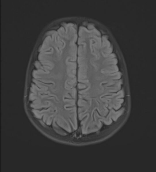 File:Brainstem glioma (Radiopaedia 70548-80674 Axial FLAIR 19).jpg