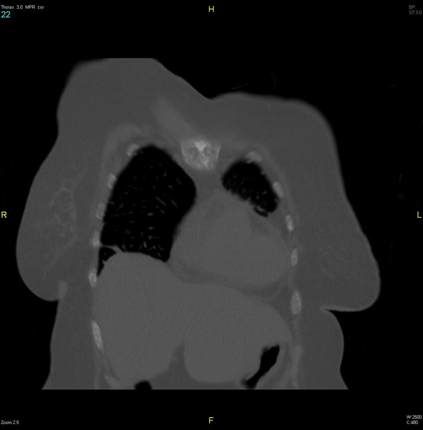 Breast primary with lung and bone metastases (Radiopaedia 40620-43228 bone window 22).jpg