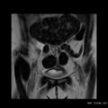 Broad ligament fibroid (Radiopaedia 49135-54241 Coronal T2 6).jpg