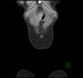 Broad ligament hernia (Radiopaedia 63260-71832 B 1).jpg