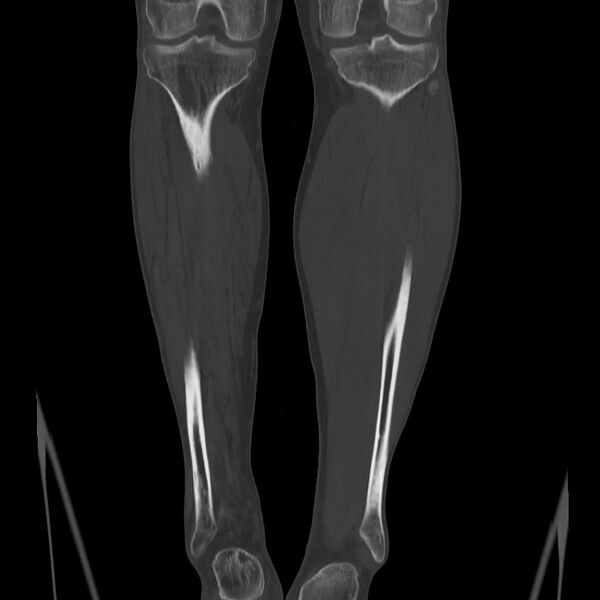 File:Brodie abscess - tibia (Radiopaedia 66028-75204 Coronal bone window 50).jpg