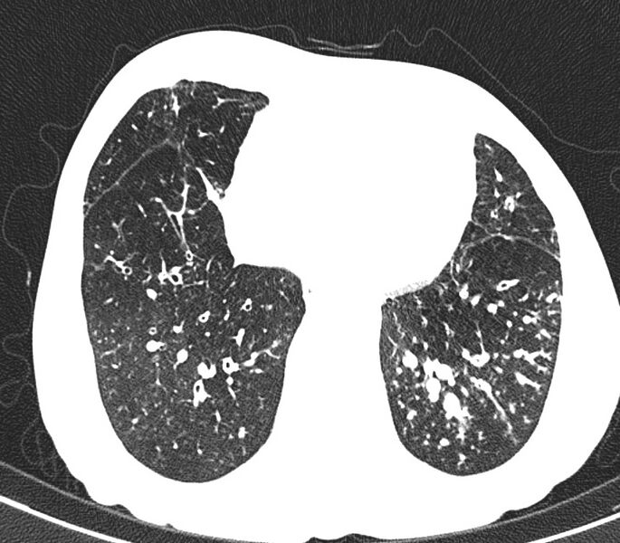 File:Bronchiolitis (Radiopaedia 24616-24887 Axial lung window 45).jpg