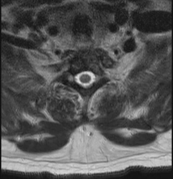 File:Brown tumors compressing the spinal cord (Radiopaedia 68442-78030 A 52).jpg