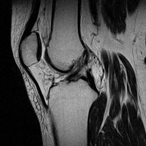 File:Bucket handle tear - medial meniscus (Radiopaedia 79028-91942 Sagittal T2 12).jpg
