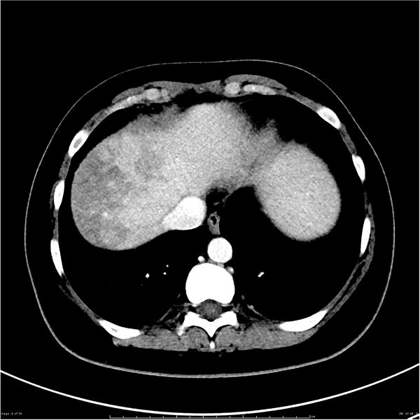 File:Budd-Chiari syndrome (Radiopaedia 27929-28177 Axial liver window 6).JPG