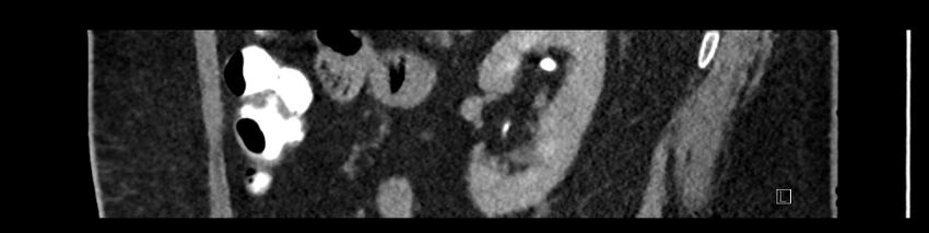Buried bumper syndrome - gastrostomy tube (Radiopaedia 63843-72575 Sagittal Inject 37).jpg
