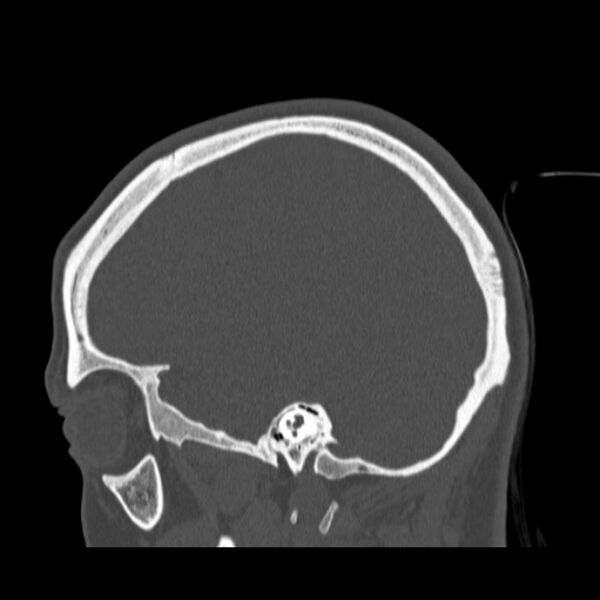 File:Calvarial osteoma (Radiopaedia 36520-38079 Sagittal bone window 33).jpg