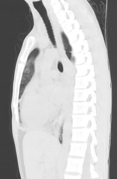 File:Cannabis-induced diffuse alveolar hemorrhage (Radiopaedia 89834-106946 Sagittal lung window 72).jpg