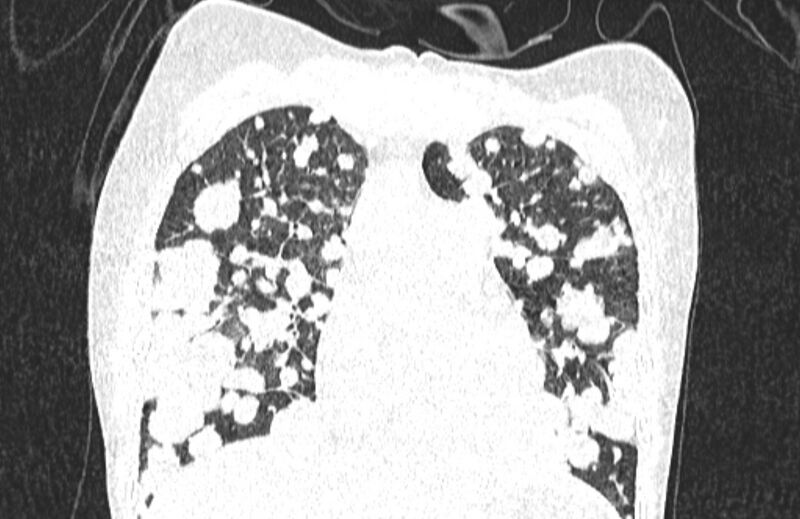 File:Cannonball metastases from breast cancer (Radiopaedia 91024-108569 Coronal lung window 50).jpg