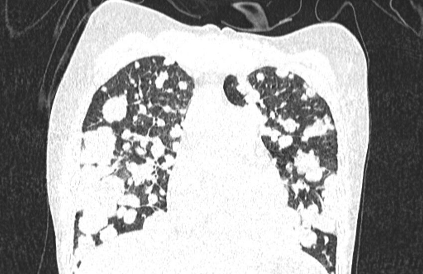 Cannonball metastases from breast cancer (Radiopaedia 91024-108569 Coronal lung window 50).jpg
