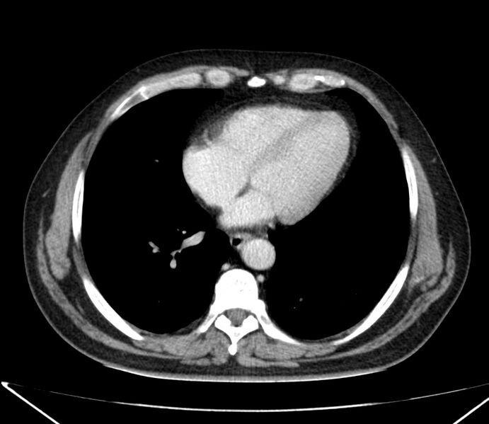 File:Carcinoid tumor with hepatic metastases (Radiopaedia 22651-22670 C 25).jpg