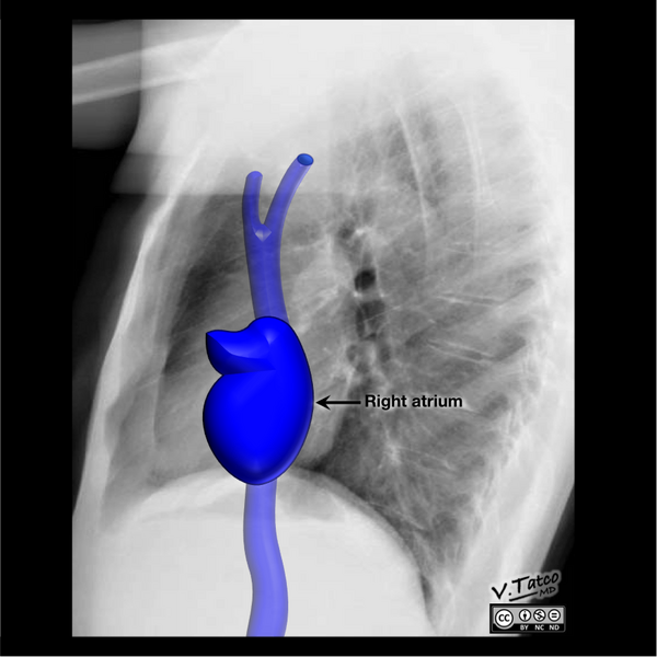 File:Cardiomediastinal anatomy on chest radiography (annotated images) (Radiopaedia 46331-50772 D 1).png