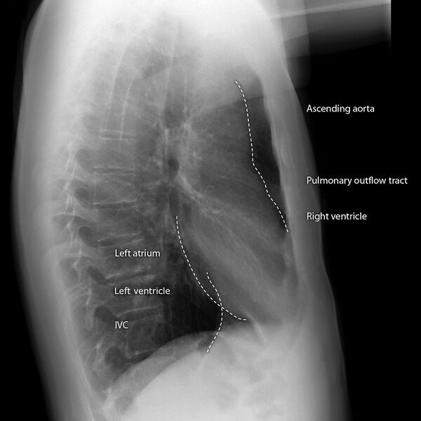 File:Cardiomediastinal outlines on chest x-ray (Radiopaedia 8470-9293 Lateral 1).jpg