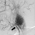 Carotid body tumor on angiography (Radiopaedia 4651-38850 A 1).jpg