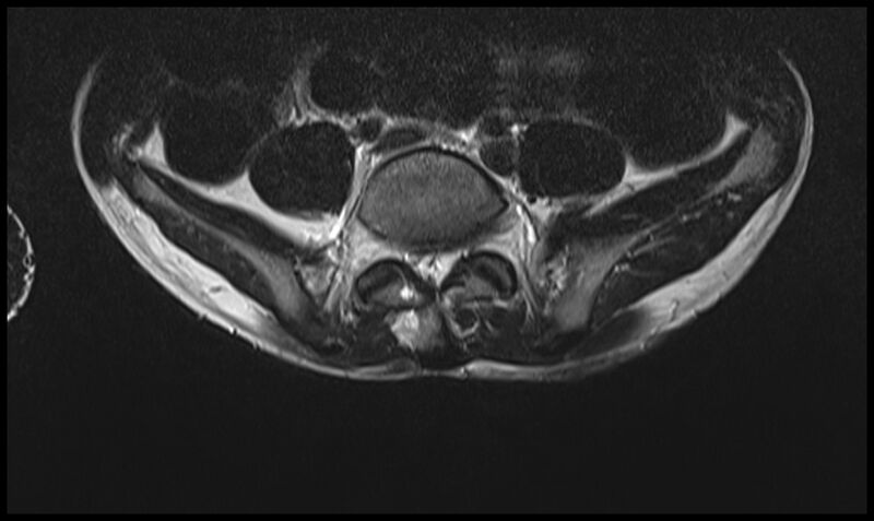 File:Caudal regression syndrome - type 1 (Radiopaedia 52113-57982 Axial T2 1).jpg