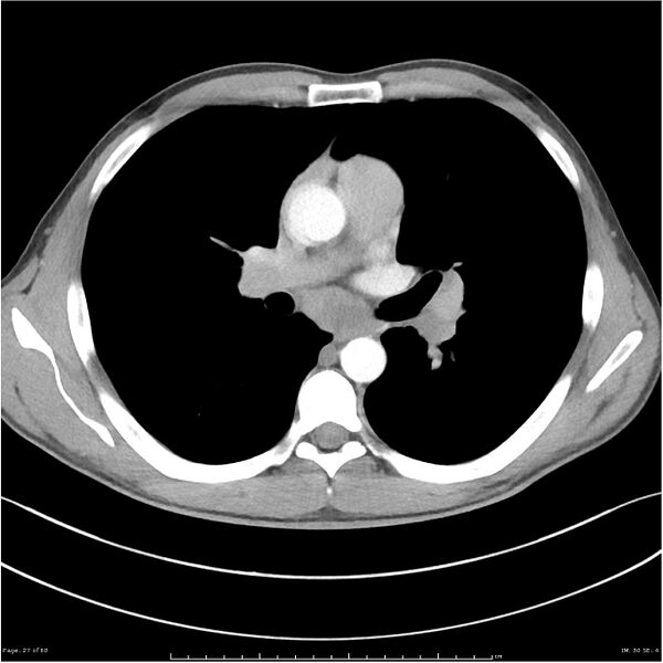 File:Cavitating lung cancer (Radiopaedia 25796-25945 C+ arterial phase 27).jpg