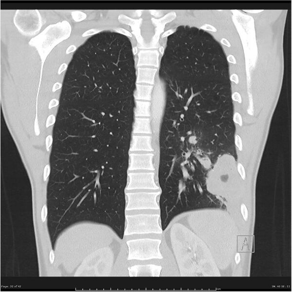 File:Cavitating lung cancer (Radiopaedia 25796-25945 lung window 32).jpg