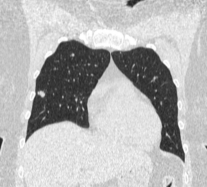 File:Cavitating pulmonary metastases (Radiopaedia 17796-17555 Coronal lung window 3).jpg