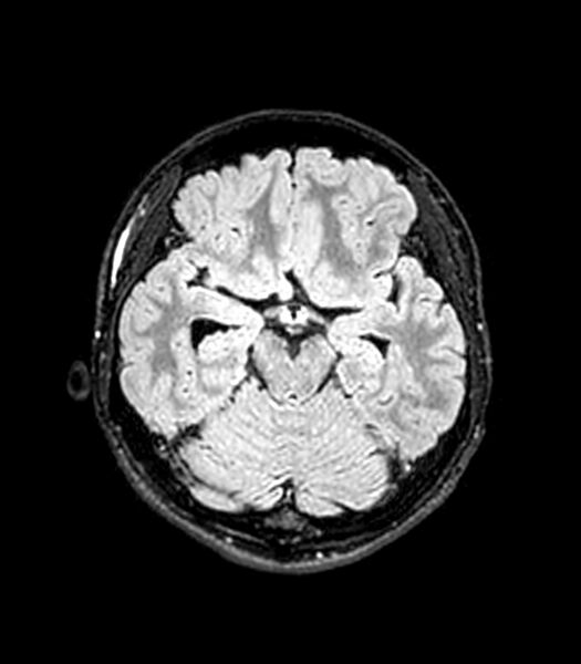 File:Central neurocytoma (Radiopaedia 79320-92380 Axial FLAIR 196).jpg