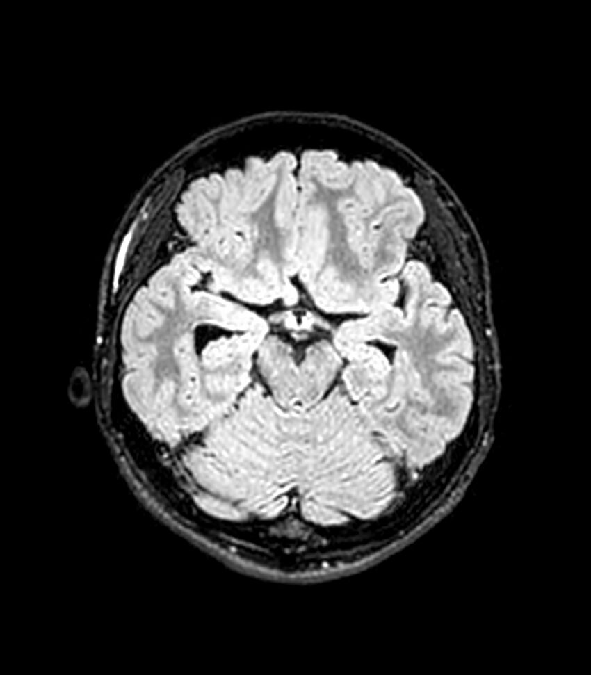 Central neurocytoma (Radiopaedia 79320-92380 Axial FLAIR 196).jpg