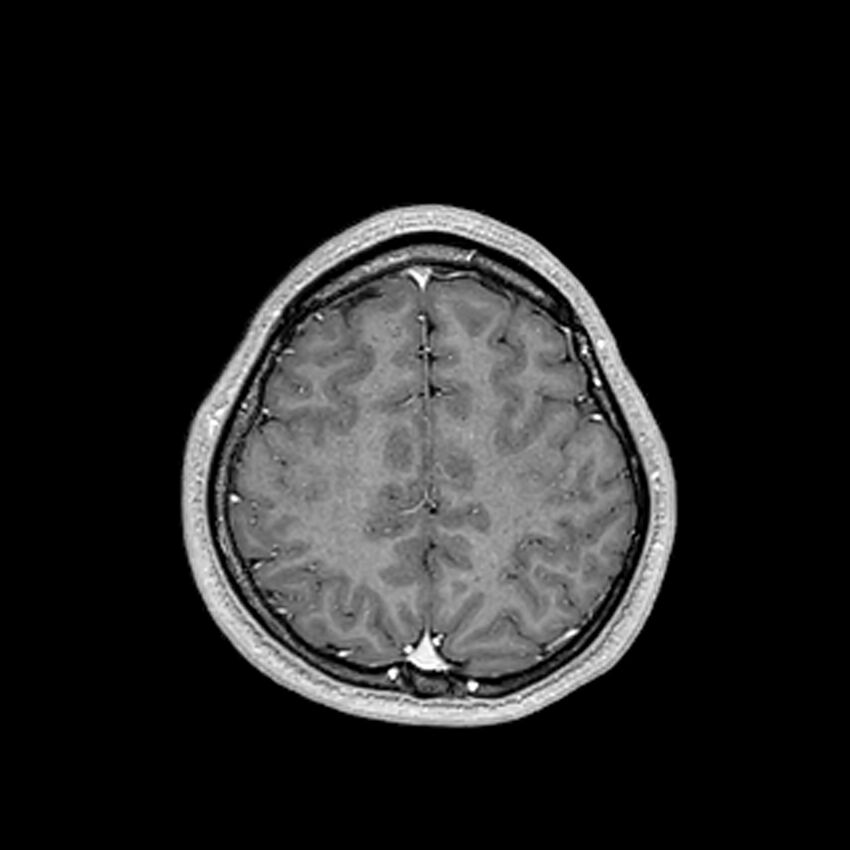 Central neurocytoma (Radiopaedia 79320-92380 Axial T1 C+ 187).jpg