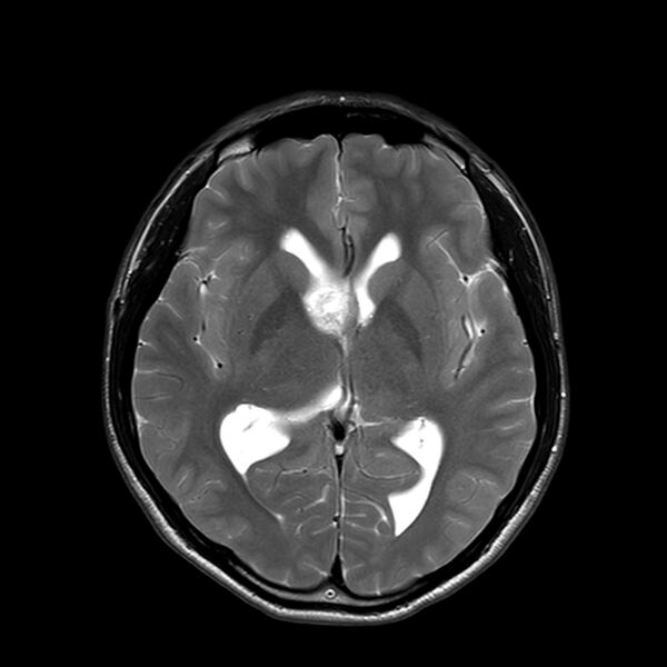 File:Central neurocytoma (Radiopaedia 79320-92380 Axial T2 14).jpg