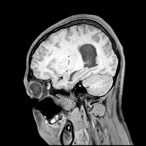 File:Central neurocytoma (Radiopaedia 79320-92380 Sagittal T1 183).jpg