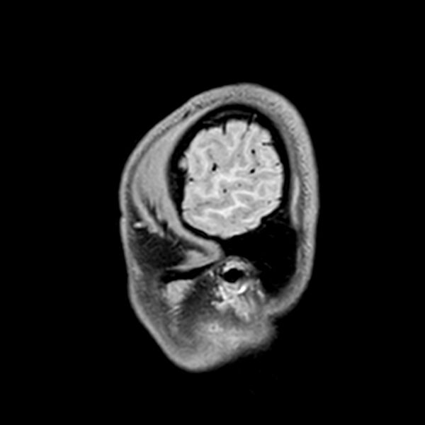 File:Central neurocytoma (Radiopaedia 79320-92380 Sagittal T1 237).jpg