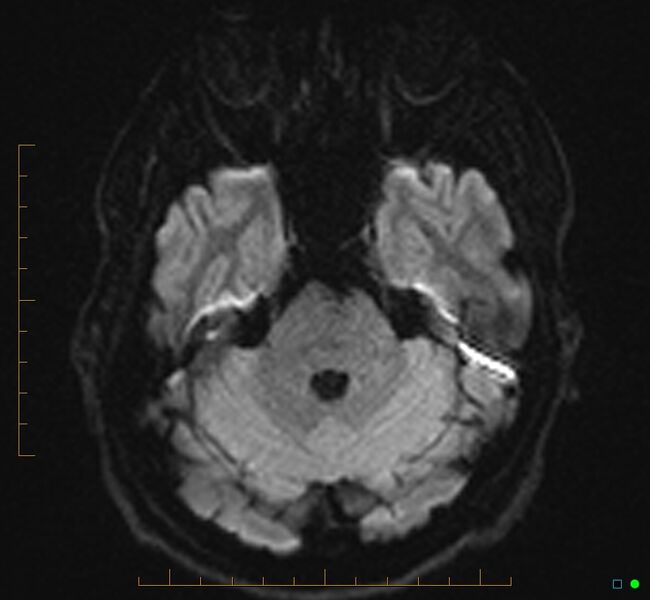 File:Cerebellar gangliocytoma (Radiopaedia 65377-74422 Axial DWI 11).jpg