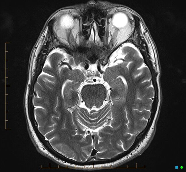 File:Cerebellar gangliocytoma (Radiopaedia 65377-74422 Axial T2 14).jpg