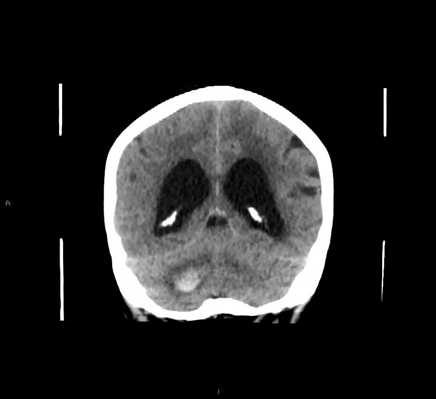 Cerebellar hemorrhage (Radiopaedia 58793-66027 Coronal non-contrast 25).jpg