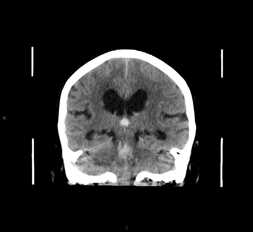 Cerebellar hemorrhage (Radiopaedia 58793-66027 Coronal non-contrast 31).jpg