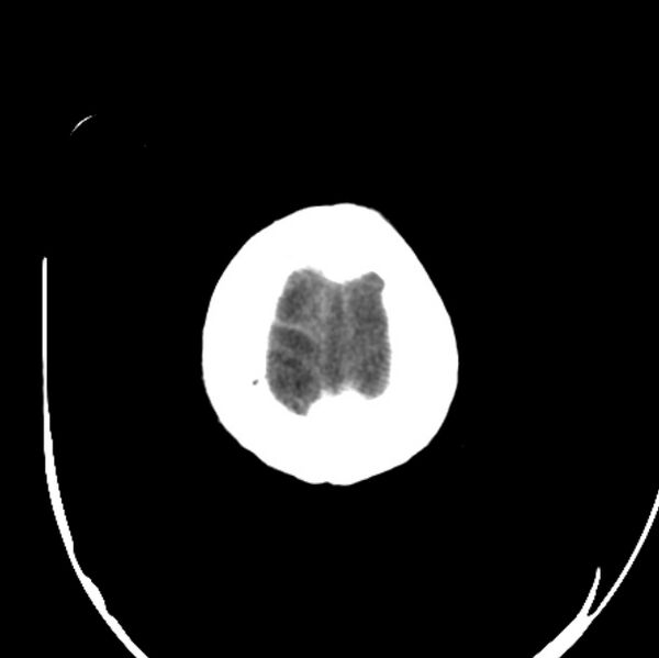 File:Cerebellar hemorrhage causing obstructive hydrocephalus (Radiopaedia 33989-35207 Axial non-contrast 50).jpg