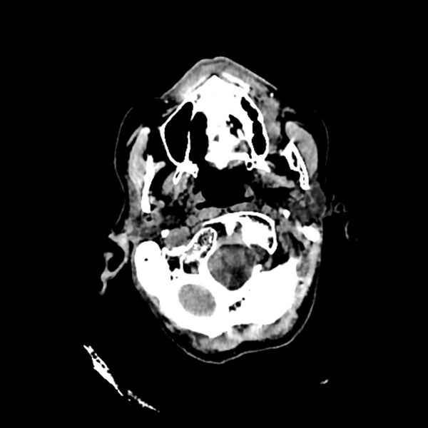 File:Cerebellar metastasis - lung tumor (Radiopaedia 69317-79145 Axial non-contrast 1).jpg