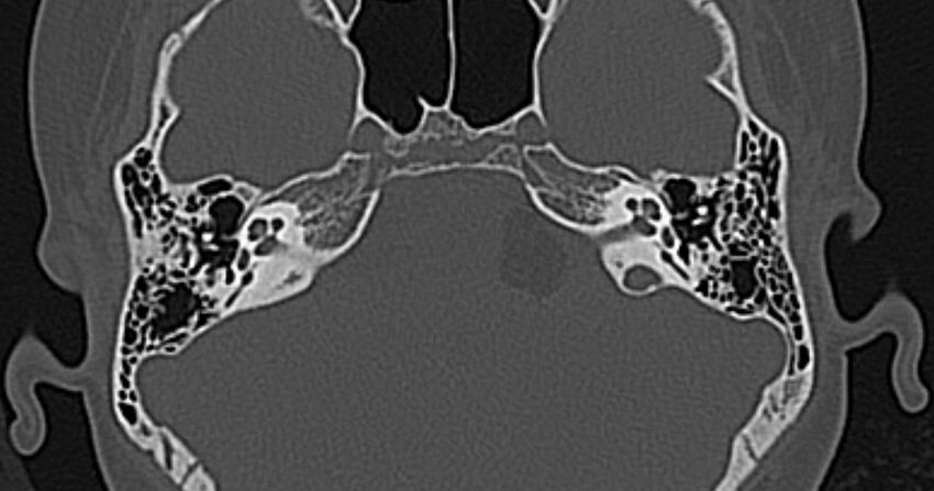 Cerebellopontine angle lipoma (Radiopaedia 57303-64242 Axial bone window 27).jpg