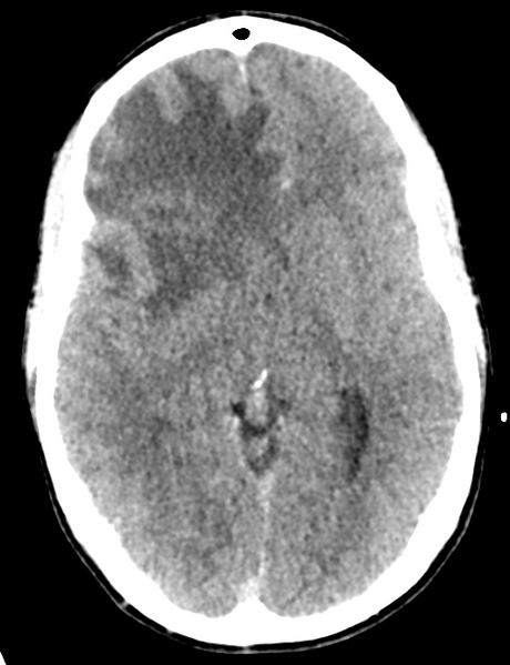 File:Cerebral abscess (Radiopaedia 60342-68008 Axial non-contrast 25).png